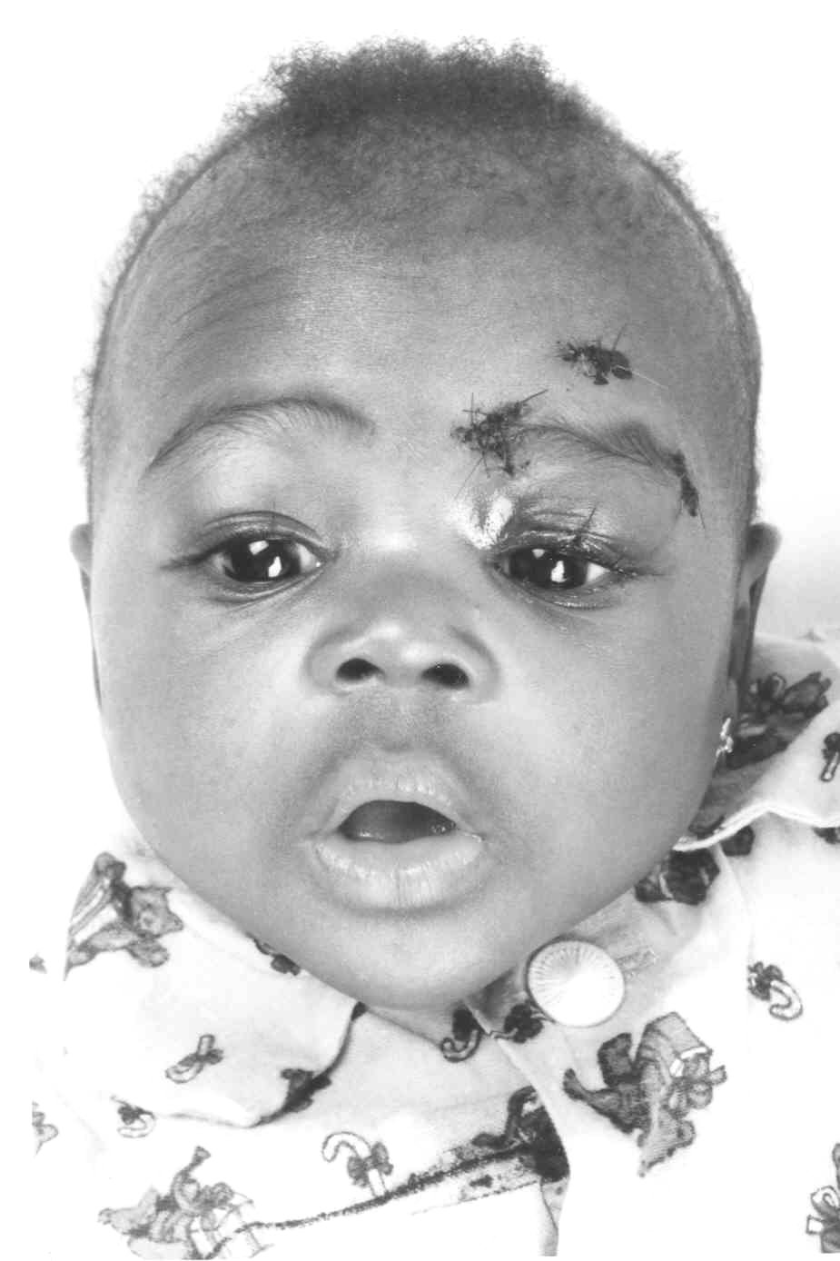 dítě po operaci vrozené ptózy