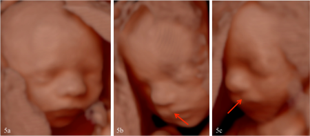 snímky z trojrozměrného ultrazvuku