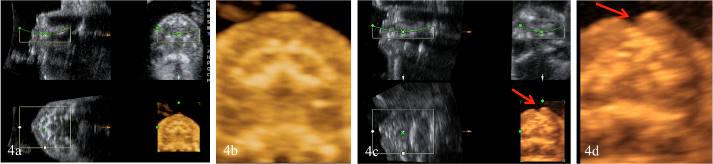 snímky z trojrozměrného ultrazvuku