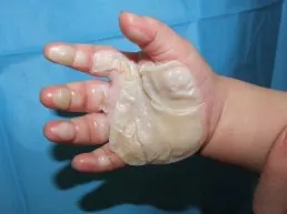 Popálená ruka