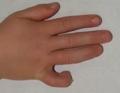 flekční kontraktura
