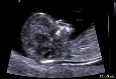 snímek z ultrazvuku