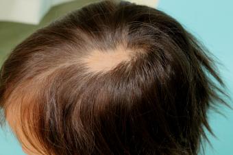 Alopecie areata