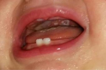 Ústa kojence s projevy moučnivky (zdroj: MUDR. Šillerová Klára)