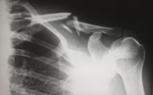 rentgen zlomeniny klíční kosti